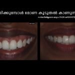 ചിരിക്കുമ്പോൾ മോണ കൂടുതൽ കാണുന്നത് സർജറിയില്ലാതെ മാറ്റിയ ബിഫോർ ആഫ്റ്റർ റിസൾട്ട് - Rootz Dental Clinic
