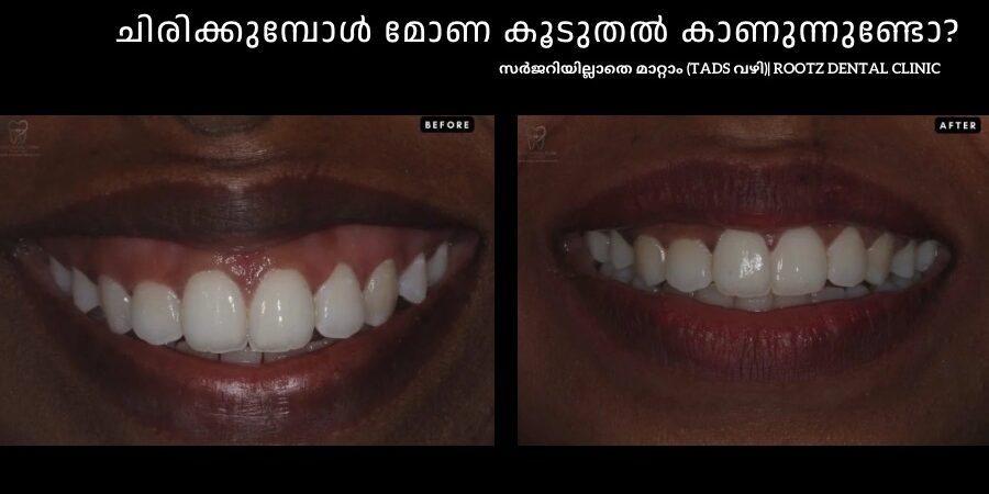 ചിരിക്കുമ്പോൾ മോണ കൂടുതൽ കാണുന്നുണ്ടോ? ട്രിവാൻഡ്രത്ത് സർജറിയില്ലാതെ ഗമ്മി സ്മൈൽ മാറ്റാം