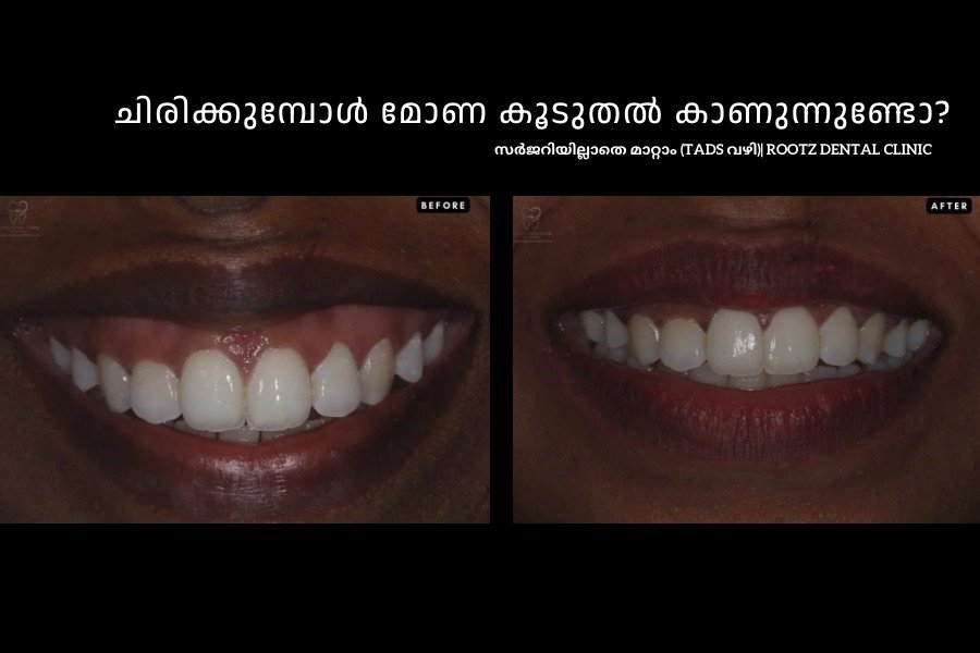 ചിരിക്കുമ്പോൾ മോണ കൂടുതൽ കാണുന്നുണ്ടോ? ട്രിവാൻഡ്രത്ത് സർജറിയില്ലാതെ ഗമ്മി സ്മൈൽ മാറ്റാം