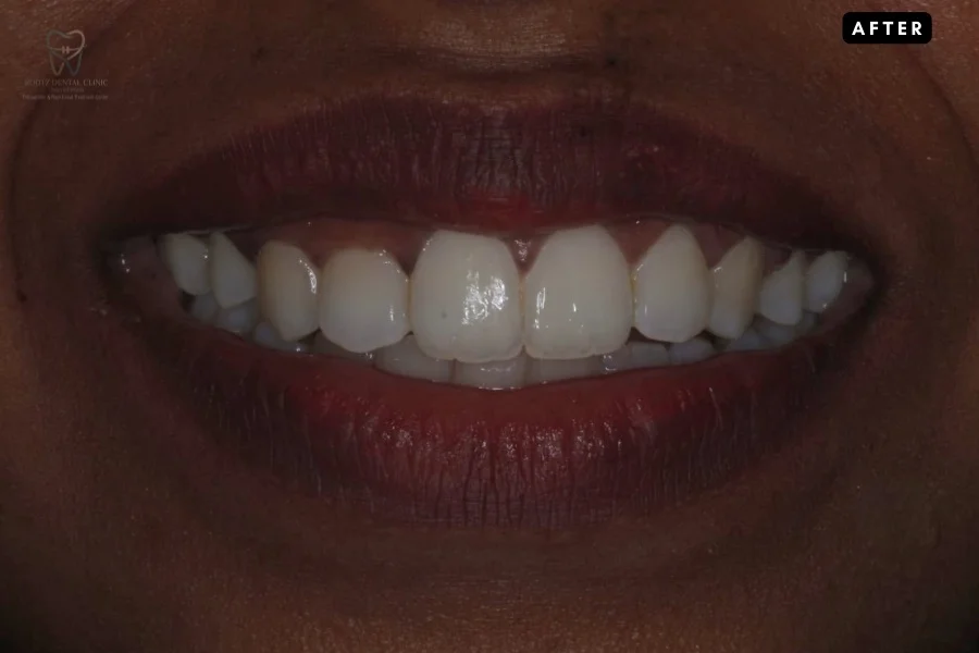 After non-surgical gummy smile correction showing balanced smile line - Dr. Arun S.