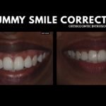 Before and after comparison of non-surgical gummy smile correction with TADs at Rootz Dental Clinic Trivandrum