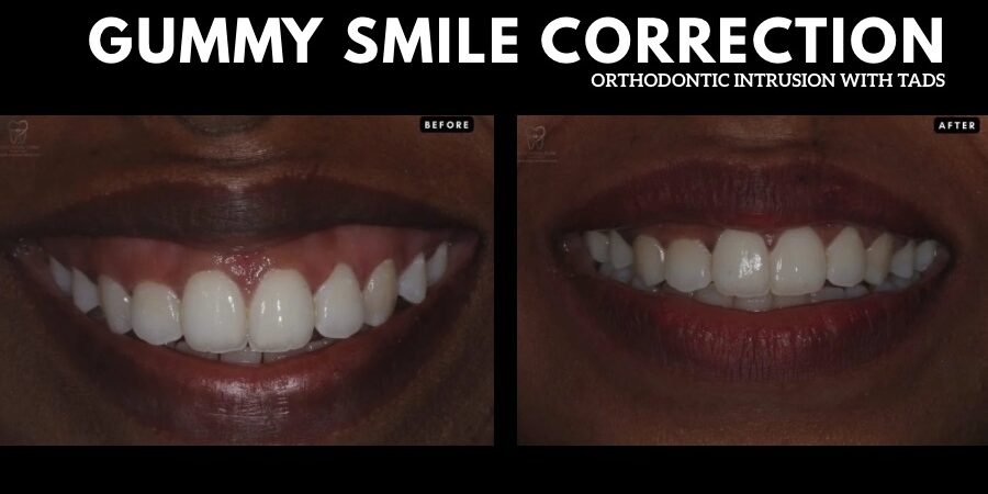 Gummy Smile Treatment in Trivandrum: Why Traditional Braces Alone Aren’t the Answer