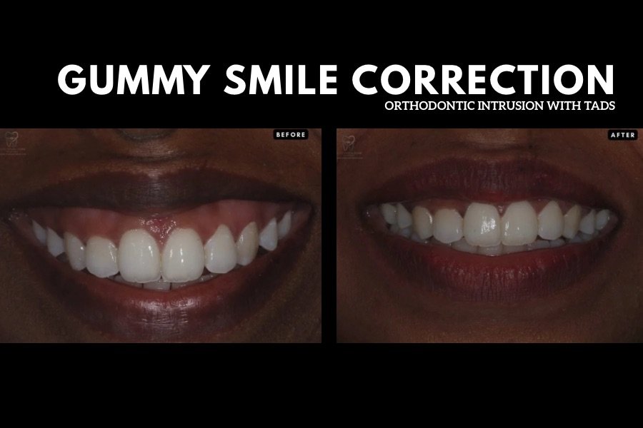Gummy Smile Treatment in Trivandrum: Why Traditional Braces Alone Aren’t the Answer