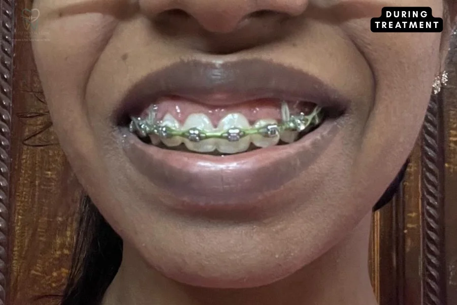 Orthodontic intrusion in progress using self-ligating braces and maxillary TADs micro-anchors